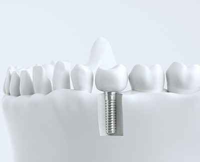 インプラント治療